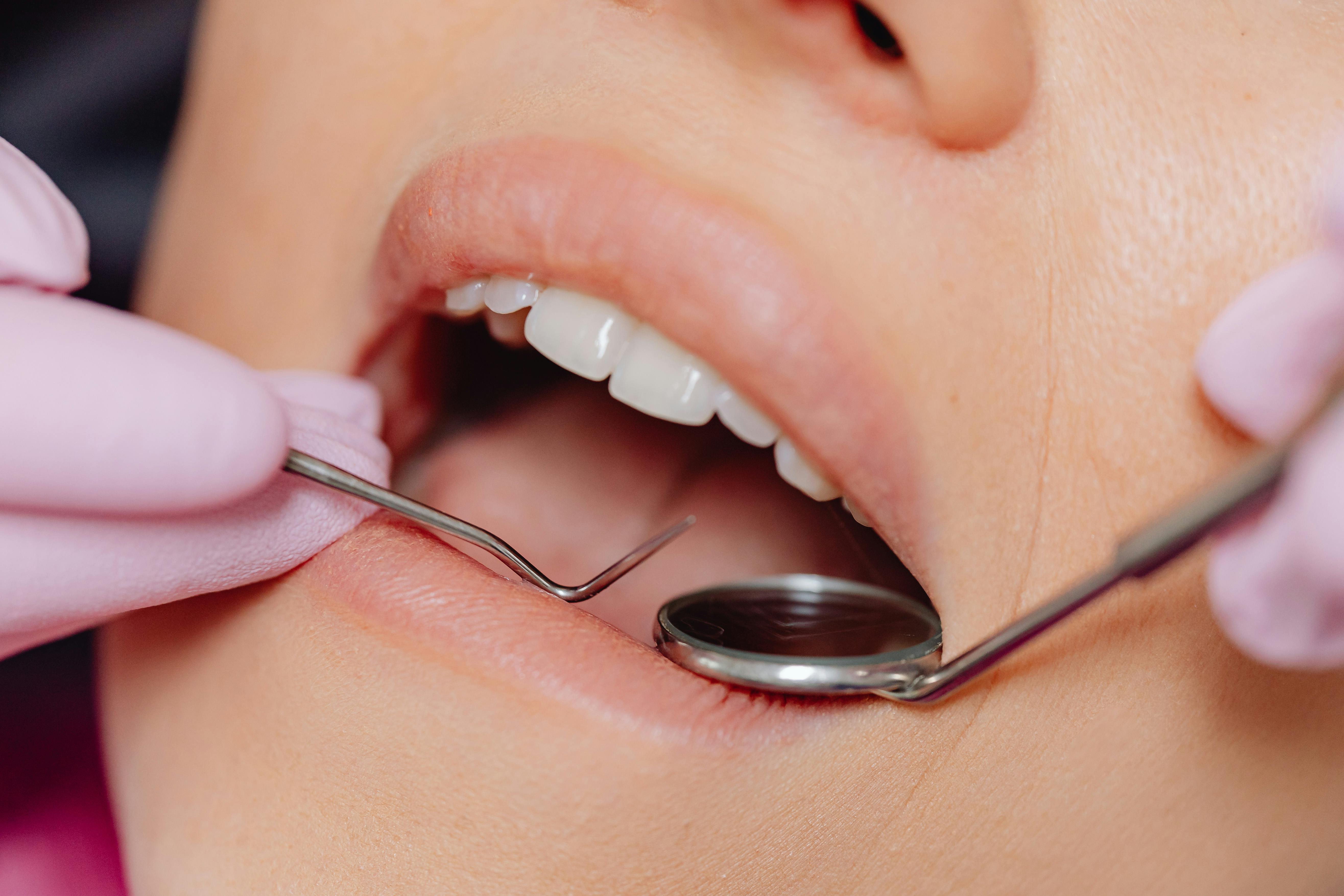 Close-up of a dental procedure with a dentist using instruments to examine a patient’s mouth, illustrating wisdom tooth extraction treatment time.